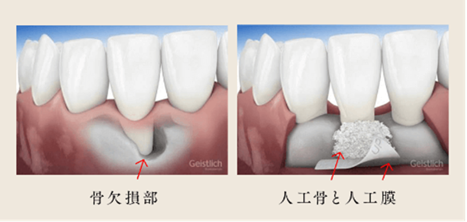 墨田区鐘ヶ淵の歯医者カルミアデンタルクリニック　再生治療