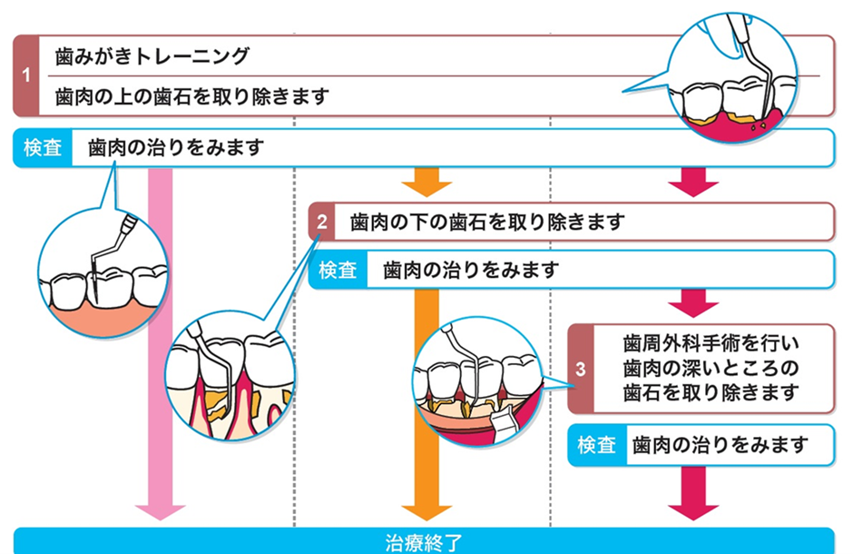 墨田区鐘ヶ淵の歯医者カルミアデンタルクリニック　日本の歯周治療