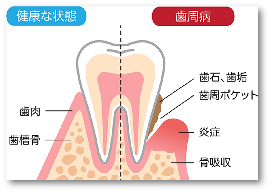 墨田区鐘ヶ淵の歯医者カルミアデンタルクリニック　歯周病とは